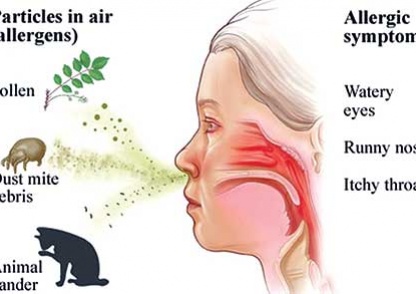 Fexofenadine a First-Line Option for Seasonal Allergic Rhinitis and Chronic Idiopathic Urticaria